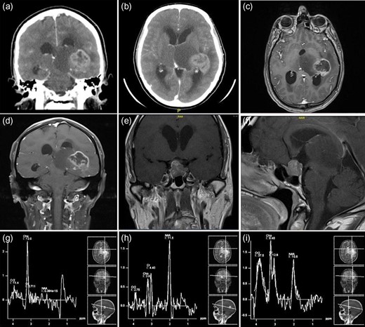 Preoperative neuroimaging of the patient—CT (a and b) and MRI ((c–f )—with contrast enhancement), showing a centrally necrotic peripherally enhancing mass lesion in the left posteromedial temporal lobe representing glioblastoma. The non-enhancing component of the tumor extended to the left thalamus. Another sellar and suprasellar mass lesion representing a pituitary macroadenoma. (g–i) The MR spectroscopy shows a very low N-acetylaspartate (NAA) and high choline keeping up with a malignant tumor.
