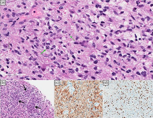 (a) High power view showing hyperchromatic glial nuclei and a couple of mitoses (green arrows). (b) Microvascular proliferation (arrows). (c) (GFAP) immunostain cytoplasmic positivity confirms astrocytic lineage; notice the negatively staining microvascular proliferation. (d) Ki-67 labeling index is high.