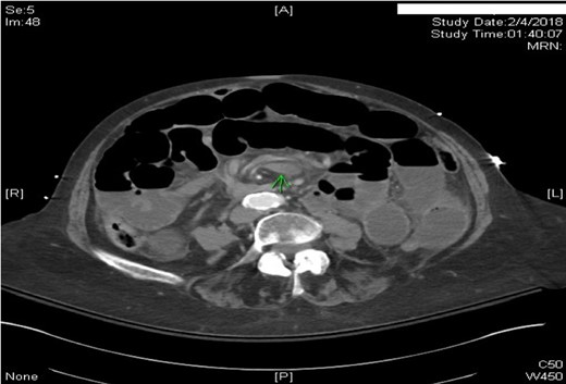 Axial CT scan of Abdomen with IV contrast: Swirling of the superior mesenteric artery and superior mesenteric vein. Proximal and mid small bowel dilatation with differential air–fluid level.