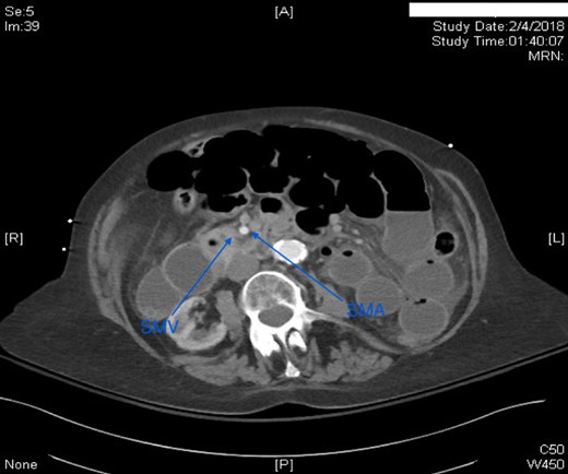 Axial CT scan of abdomen with IV contrast. SMV was located to the right of SMA.