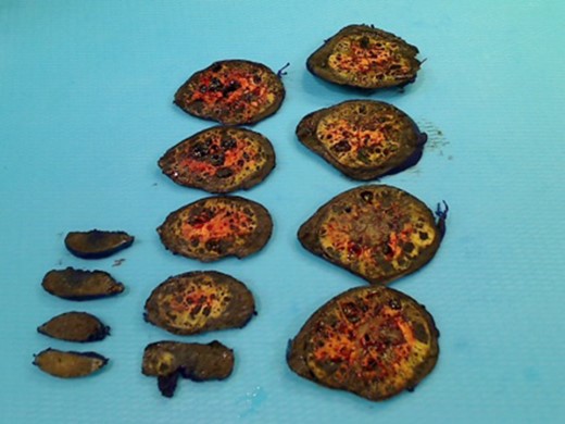 Circumscribed intrathyroidal 4.2 × 3.5 cm2 mass.