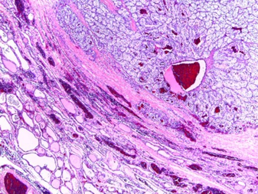 Normal thyroid tissue on the lower left corner; clear cells in the upper right quadrant.