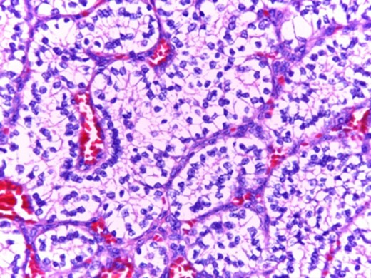 Predominantly ‘clear cell’ morphology.
