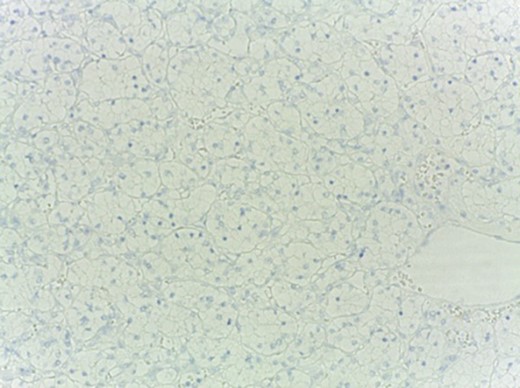 TTF-1 negative.