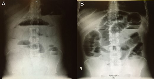 Initial abdominal x-ray showing multiple air–fluid levels (A) and a dilated bowel (B).