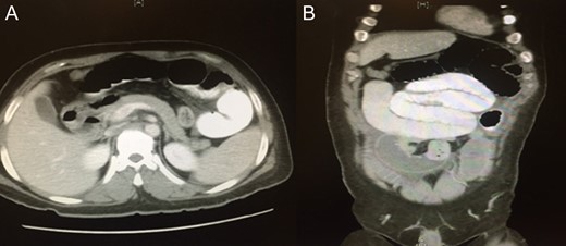 A computed tomography of the abdomen and pelvis showing small bowel obstruction at the level of the proximal ileal loops, with a transition point between dilated proximal loops and the collapsed terminal ileal loops.