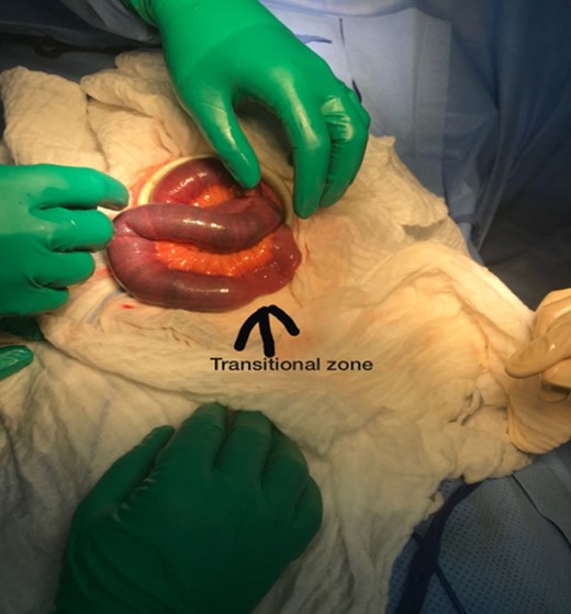 Image showing intraoperative finding of obstructing mass with transitional zone (black arrow).