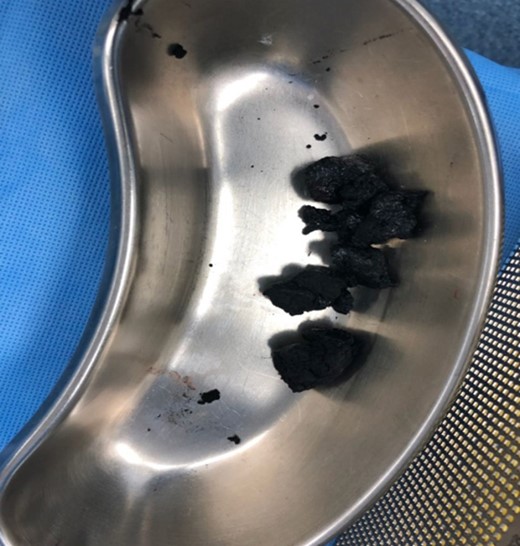 Image showing charcoal bezoars after removal from the small bowel.