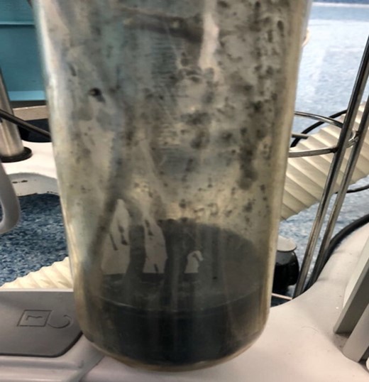 Suction container containing charcoal-stained fluid.