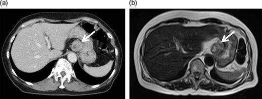 Enhanced computed tomography (CT) and magnetic resonance imaging (MRI). Contrast-enhanced CT (a) and MRI (b) images showed a well-defined solid mass of ~3 cm in diameter lying adjacent to the stomach, with some heterogeneity.