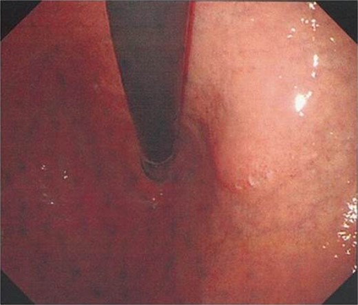 Upper endoscopy findings. Upper endoscopy showed the lessor curvature of the stomach to be compressed extraluminally without mucosal abnormalities.