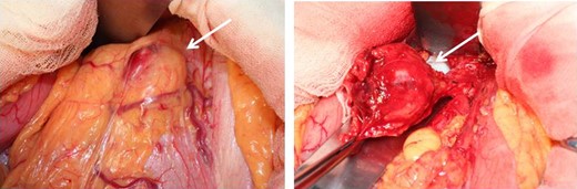 Operative findings. At laparotomy, a well-encapsulated tumor was found in the lesser omentum. It was slightly adhered to the stomach wall but was removed without difficulty.