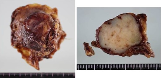 Macroscopic findings of the resected specimens. The excised tumor, which was 35 × 30 × 25 mm3 in size, had a white cut surface without necrosis or hemorrhage.