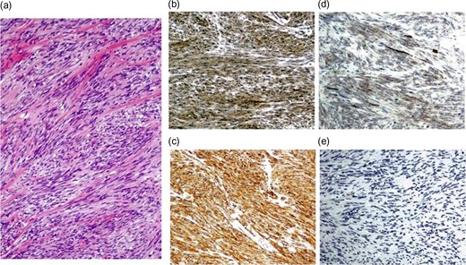 Pathological findings of the resected specimens. Histologically, the tumor was composed of spindle-sharped cells (a). Immunohistochemistry revealed the tumor cells to be positive for c-KIT (b), CD34 (c) and α-SMA (d) and negative for S-100 protein (e).