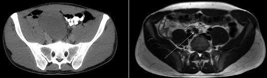 Axial view of CT-abdomen (left) and MRI-abdomen 1 year later. A pear-shaped lesion is seen on the CT, which regressed as seen on the MRI (arrow).