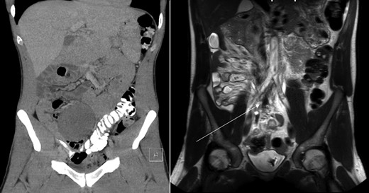 Coronal view of CT-abdomen (left) and MRI-abdomen 1 year later. The lesion has regressed significantly (arrow).