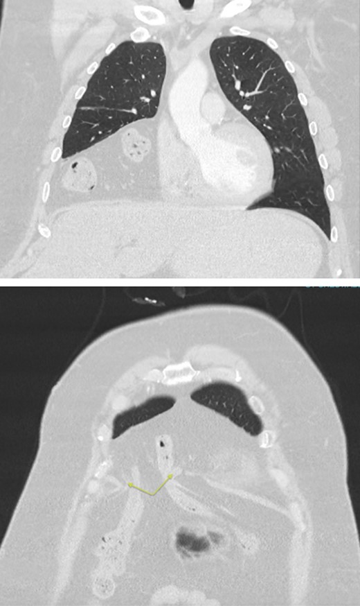 CT chest/abdomen/pelvis with large volume Morgagni hernia containing loops of bowel in the right hemithorax. Arrows highlighting the diaphragmatic defect.