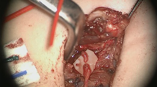 Approximated left ansa cervicalis branch and left recurrent laryngeal nerve (RLN).