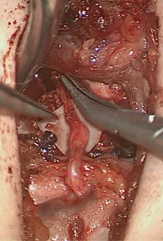 Ansa-left RLN anastomosis.
