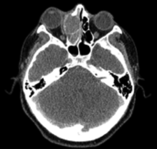 Pre-operative CT scan. SNUC.