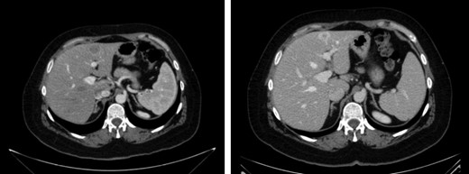 CT scan first relapse. Liver metastases: sIII and sVII 2.2 CT scan after neoadjuvant chemotherapy.