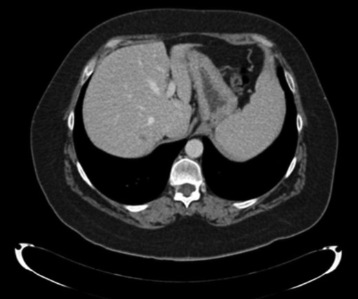 CT scan. Liver metastases sVII.