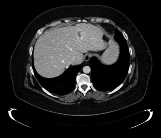 Liver metastases LHL.