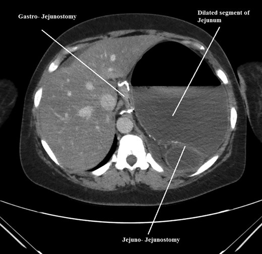 Axial CT scan of abdomen and pelvis showing, gastro-jejunostomy, Jejuno-Jejunostomy and dilated proximal small bowel segment.