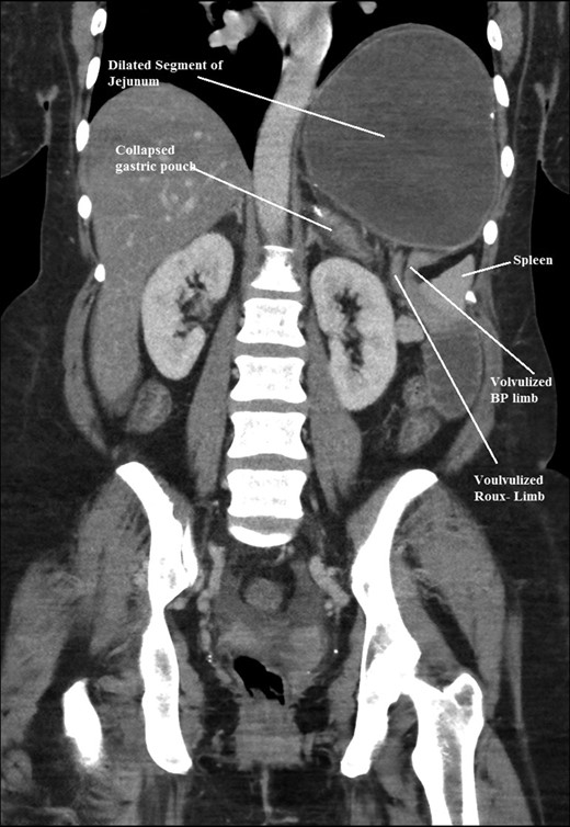 Coronal CT scan of abdomen and pelvis showing volvulized bilio- pancreatic and Roux limbs within the obstructed segments in the splenic hilar region.
