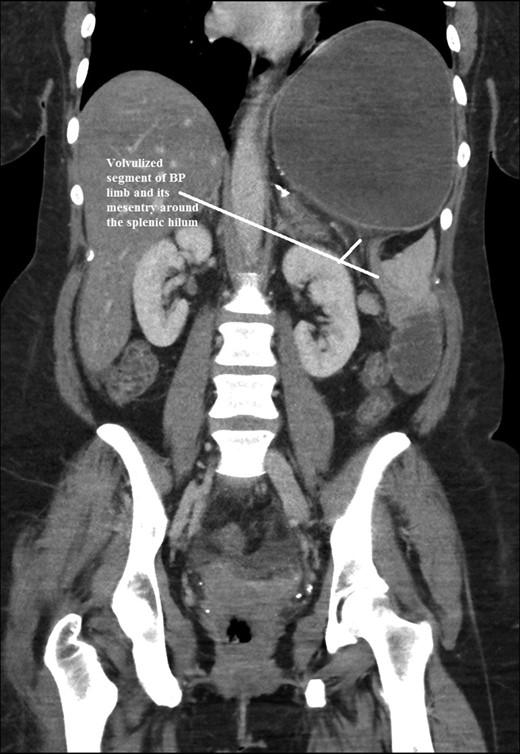 Coronal CT scan of abdomen and pelvis showing Volvulized segment of bilio-pancreatic limb and its mesentery in the spleen hilum.