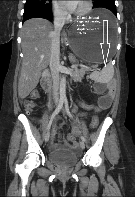 Coronal CT scan of abdomen and pelvis showing Dilated jejunal segment causing caudad splenic displacement.