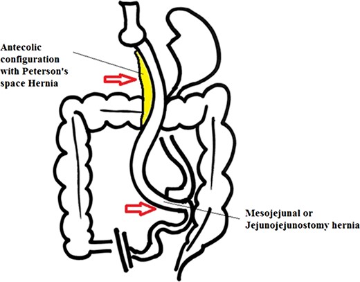 Antecolic Approach with internal hernias at two possible sites.
