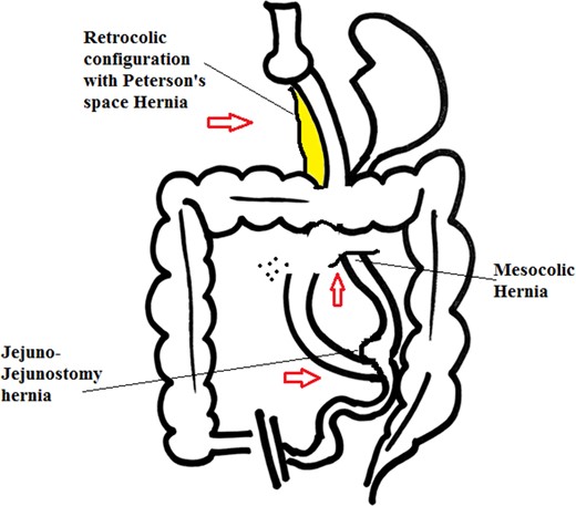 Retrocolic approach with internal hernias at three possible sites.