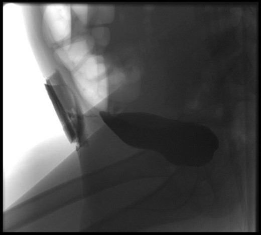 Cystogram showing tracking of contrast to the abdominal wall, and soaking the overlying dressing.