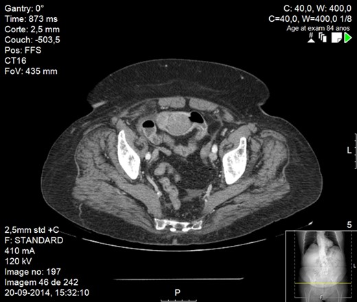 CT scan image showing small bowel obstruction due to polypoid intraluminal masses.