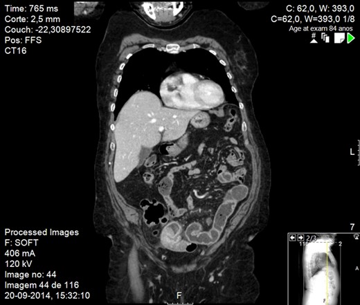 CT scan image showing small bowel obstruction due to polypoid intraluminal masses.
