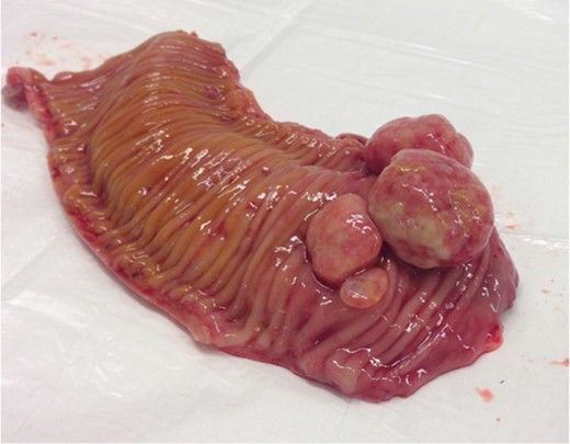Surgical specimen: opened small bowel with several polypoid masses arising from the lumen.