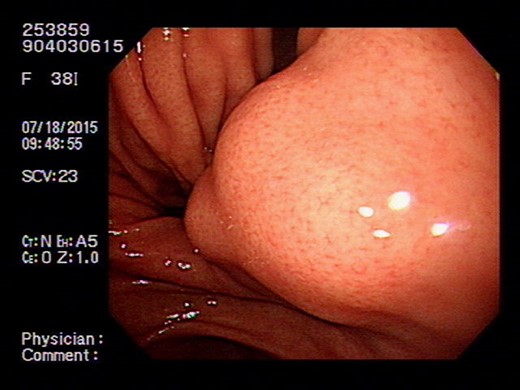 Endoscope showing intraluminal tumor with normal mucosal covering.