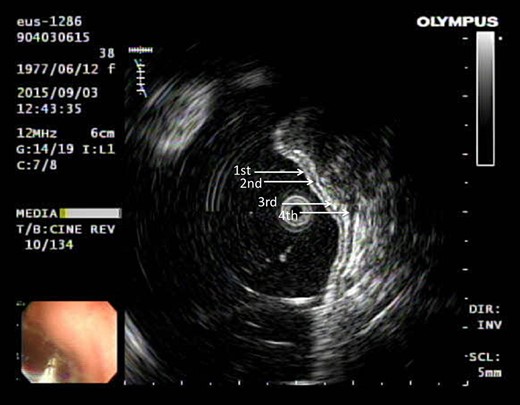 Ultrasonography showing tumor arising from the fourth layer of the gastric wall.