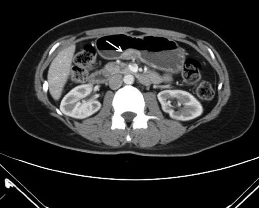 CT imaging revealing submucosal tumor at gastric antrum.