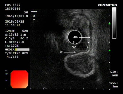 Gastrointestinal stromal tumor (GIST) under ultrasonography also shares similar feature by arising from the fourth layer of the gastric wall.