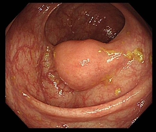 Colonoscopy image of the ascending colon showing submucosal lesion.