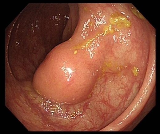 Colonoscopy image of the ascending colon showing submucosal lesion.