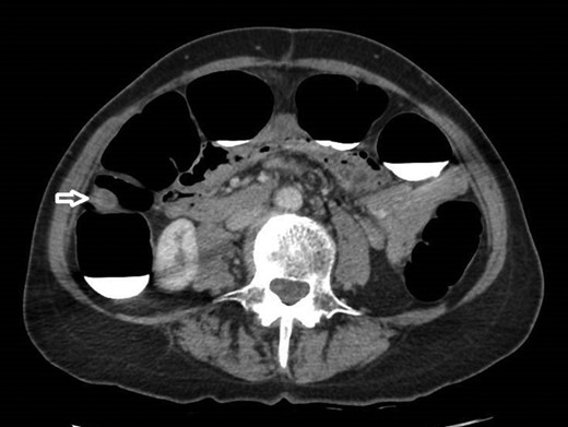 12 mm polypoidal mass (white arrow) visible on axial image of post-contrast CTVC.