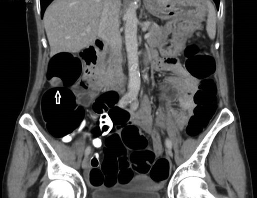 12 mm polypoidal mass (white arrow) visible on coronal image of post-contrast CTVC.