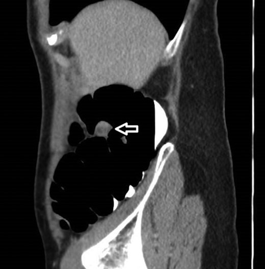 12 mm polypoidal mass (white arrow) visible on sagittal image of post-contrast CTVC.