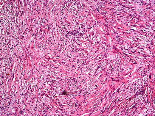 H&E staining showing submucosal tumour with spindle cells and verocay bodies.