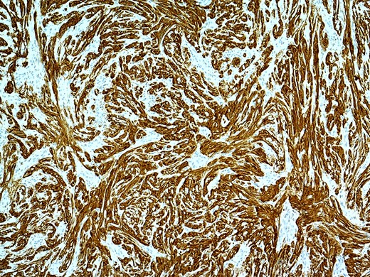 Immunohistochemical staining- strongly positive for S100.