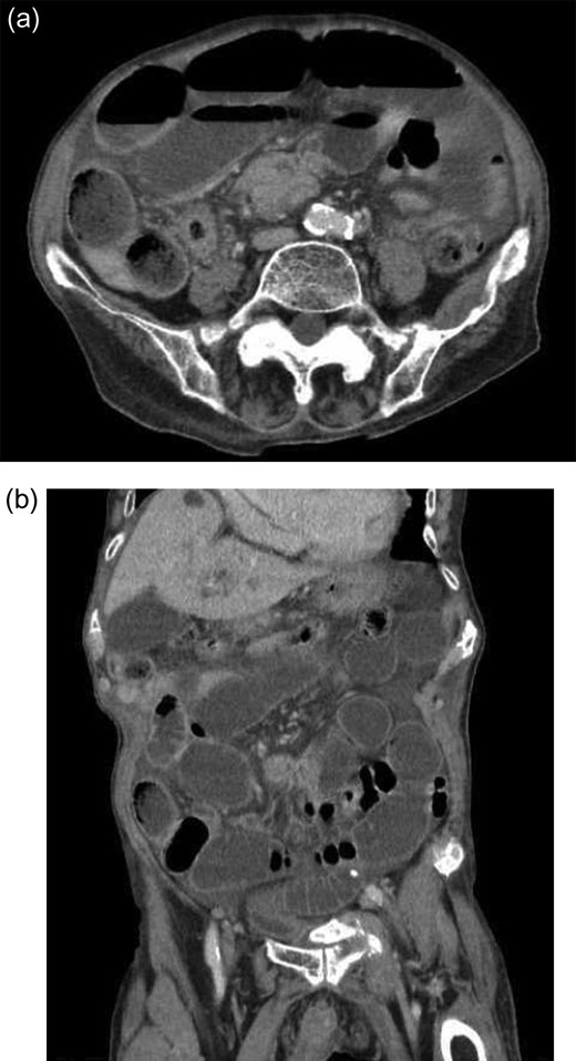 (a and b) Computed tomography showing the distended ileum that adhered to the cecum with thickened walls. There are no signs of free air, massive ascites or intestinal ischemia.