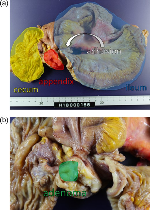 (a and b) Formalin-fixed resected tissue shows no other potential cause of appendiceal foramen obstruction (such as a fecalith) other than a pedunculated polyp that is ~5 mm in size.